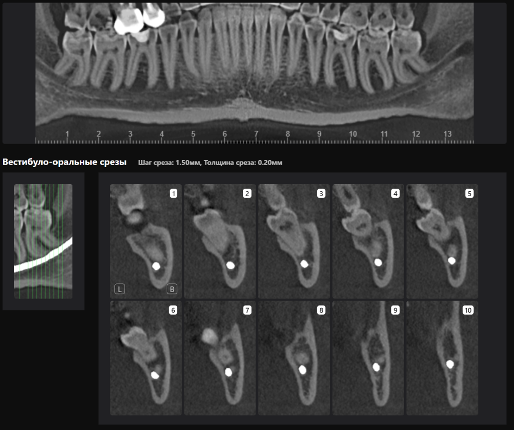 Пример из практики - планирование атравматичного удаления 8 зубов 8 Пример из практики - планирование атравматичного удаления 8 зубов 7