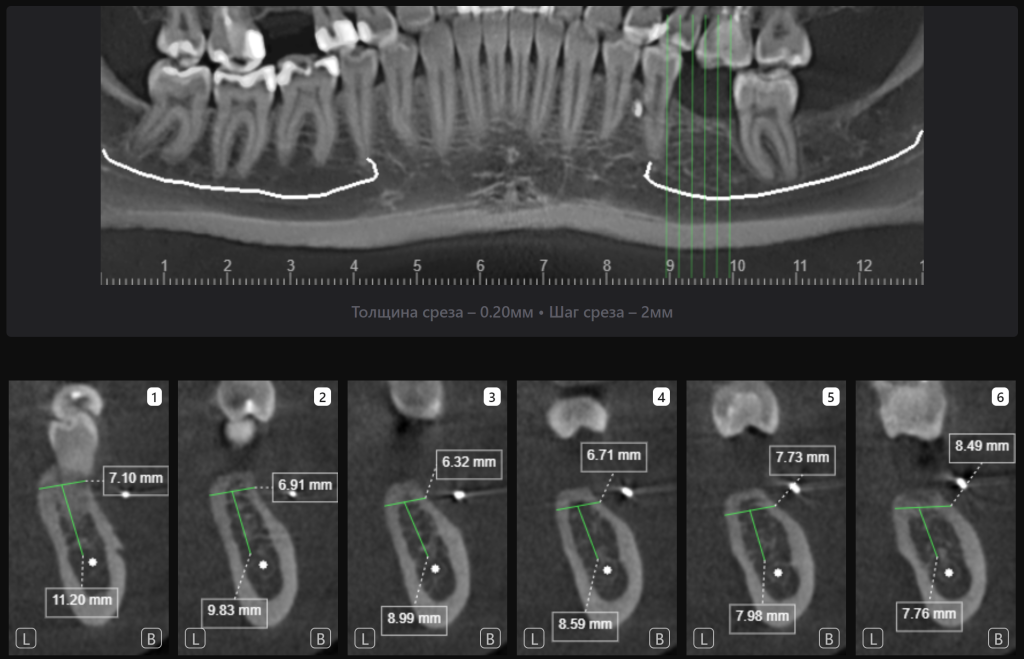 Пример из практики - планирование имплантации в области зуба 3.6 8 Пример из практики - планирование имплантации в области зуба 3.6 7