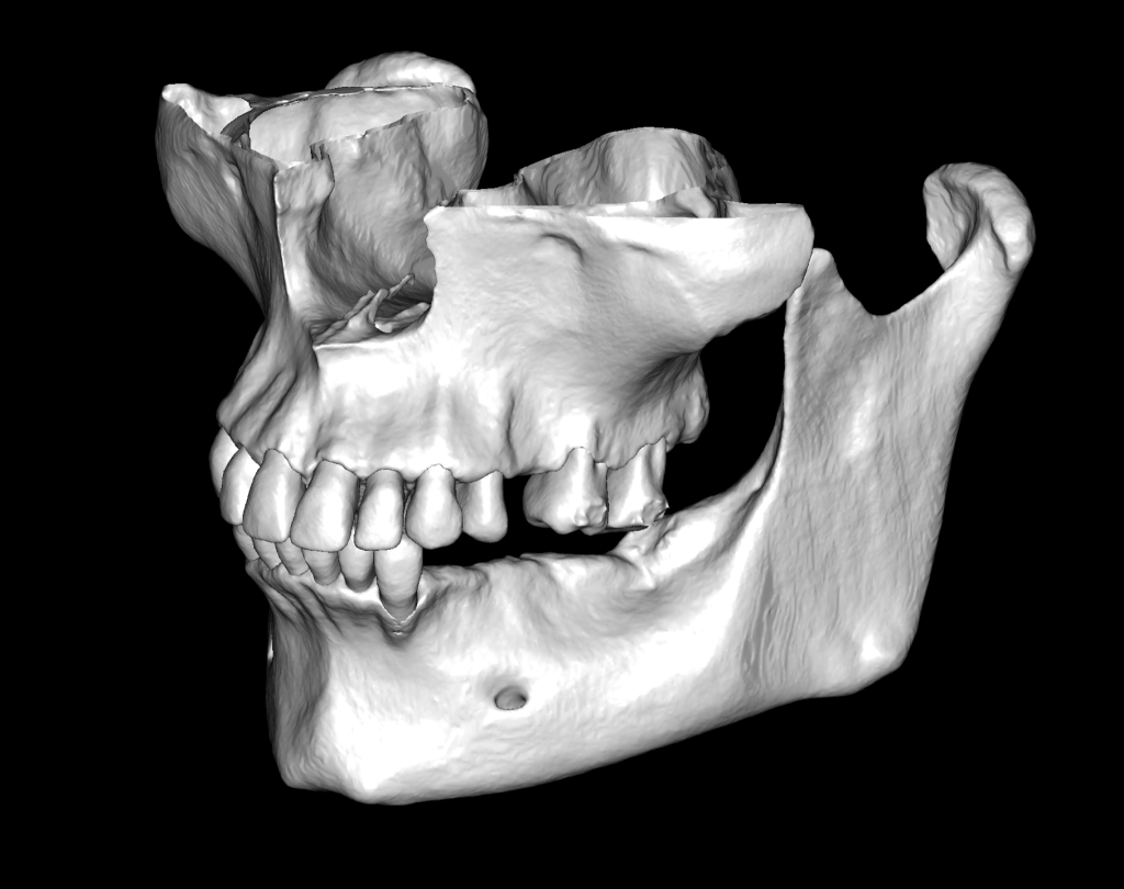 Case study - Reconstruction of the alveolar ridge using Diagnocat AI 8 Case study - Reconstruction of the alveolar ridge using Diagnocat AI 7