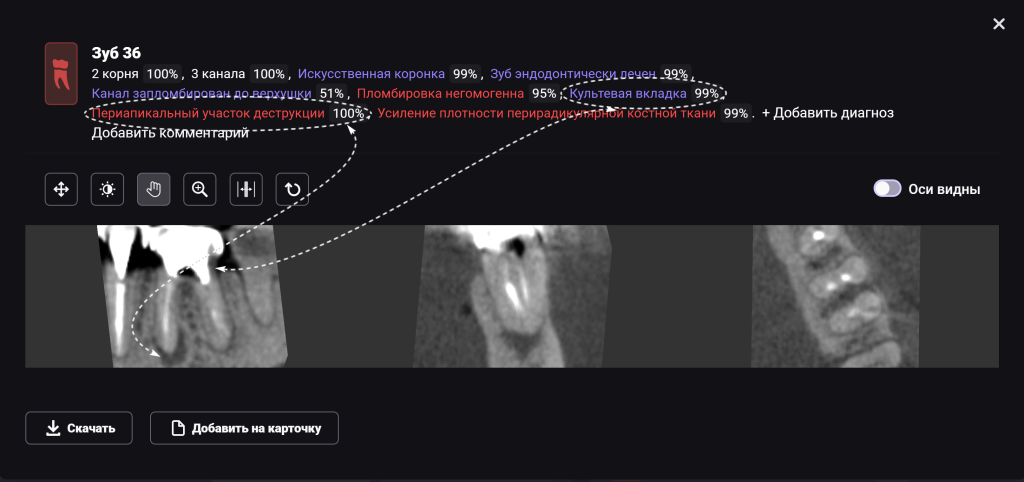 Случай из практики - планирование тотальной ортопедической реабилитации 8 Случай из практики - планирование тотальной ортопедической реабилитации 7