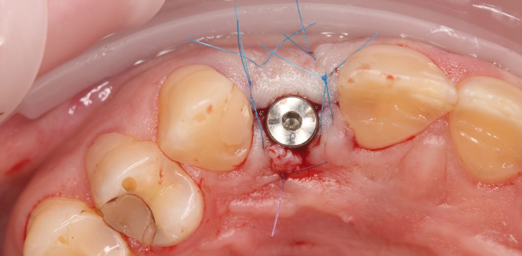 Aesthetic zone implant plan 8 Aesthetic zone implant plan 7