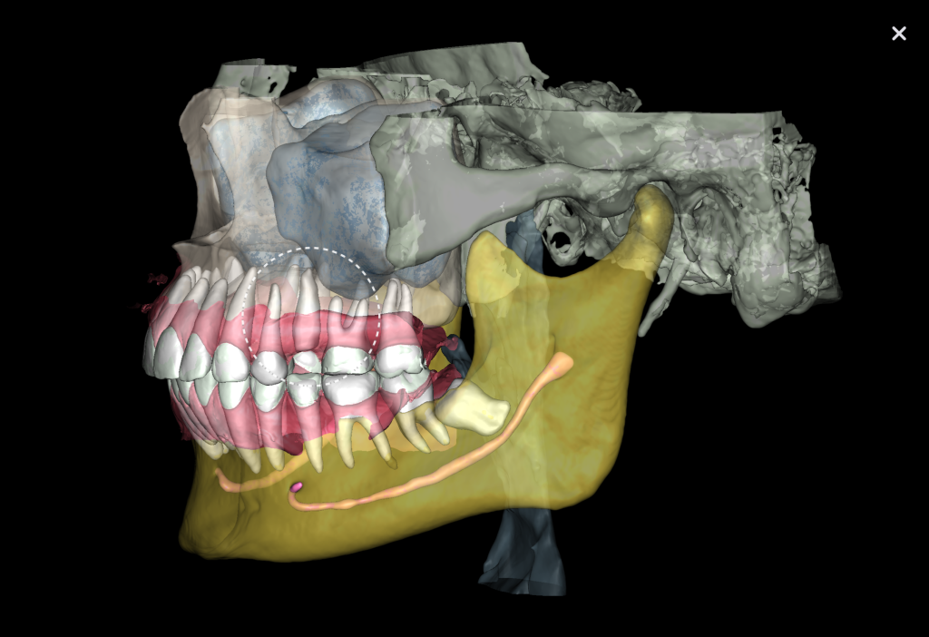 Case study: Implant planning for missing tooth 25 (universal 13) 8 Case study: Implant planning for missing tooth 25 (universal 13) 7
