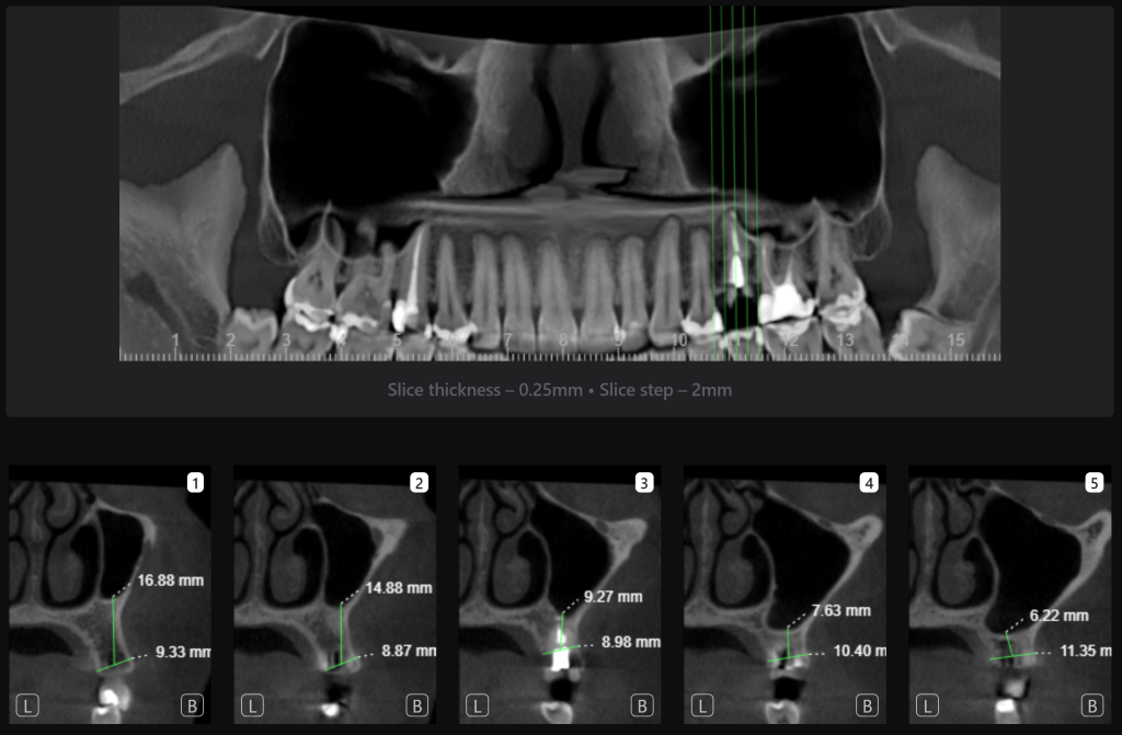 Случай из практики - планирование одномоментной имплантации с помощью ИИ Diagnocat 8 Случай из практики - планирование одномоментной имплантации с помощью ИИ Diagnocat 7