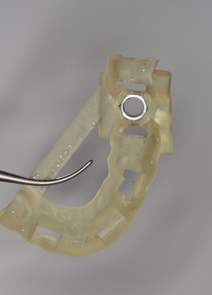 Case study: Implant planning for missing 36 (Universal 19) 8 Case study: Implant planning for missing 36 (Universal 19) 7