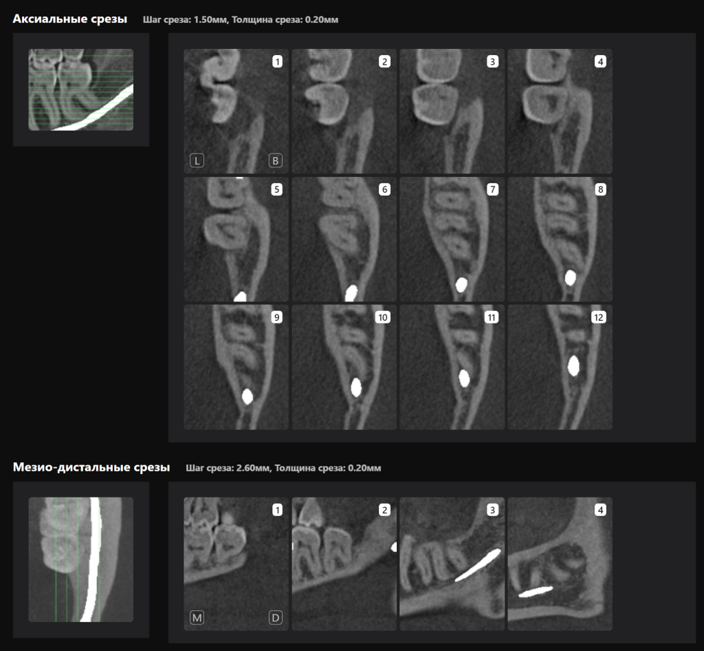 Пример из практики - планирование атравматичного удаления 8 зубов 10 Пример из практики - планирование атравматичного удаления 8 зубов 9