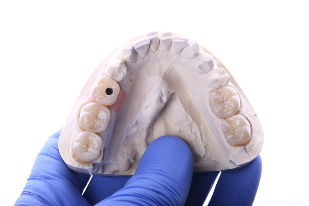 Планирование имплантации 10 Планирование имплантации 9