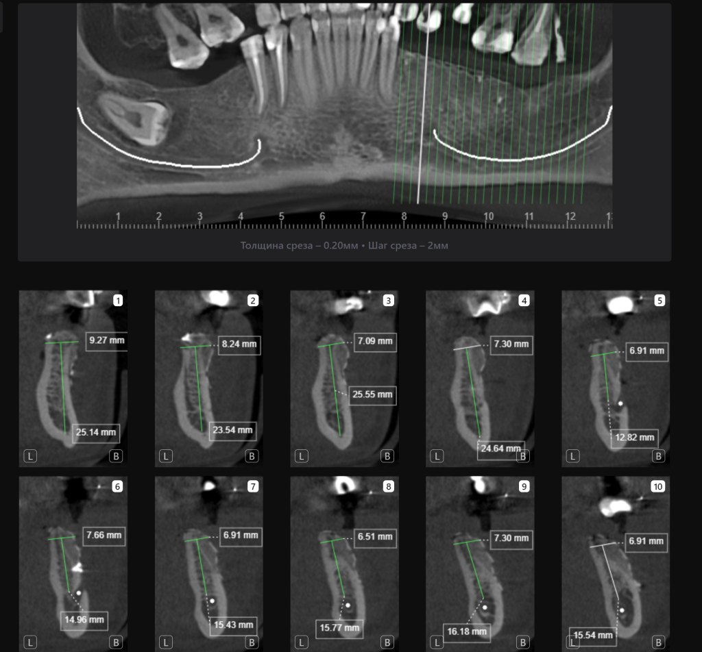 Пример из практики - планирование реконструкции альвеолярного гребня вместе с Diagnocat 10 Пример из практики - планирование реконструкции альвеолярного гребня вместе с Diagnocat 9