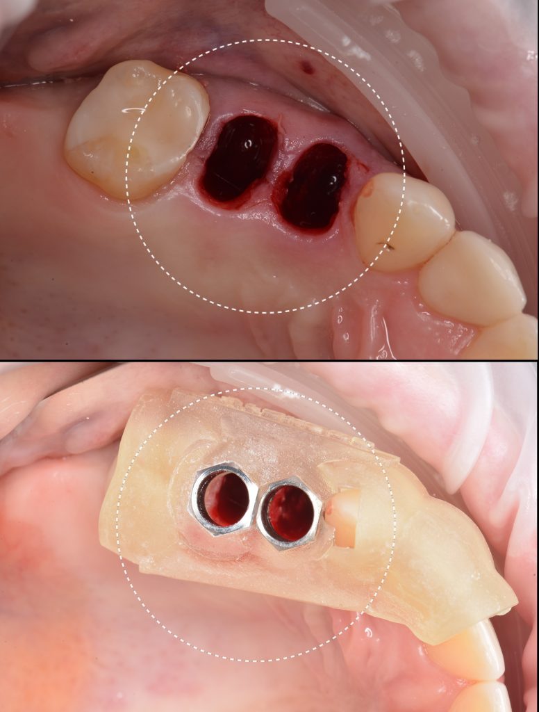 Implant placement using Diagnocat modules 10 Implant placement using Diagnocat modules 9