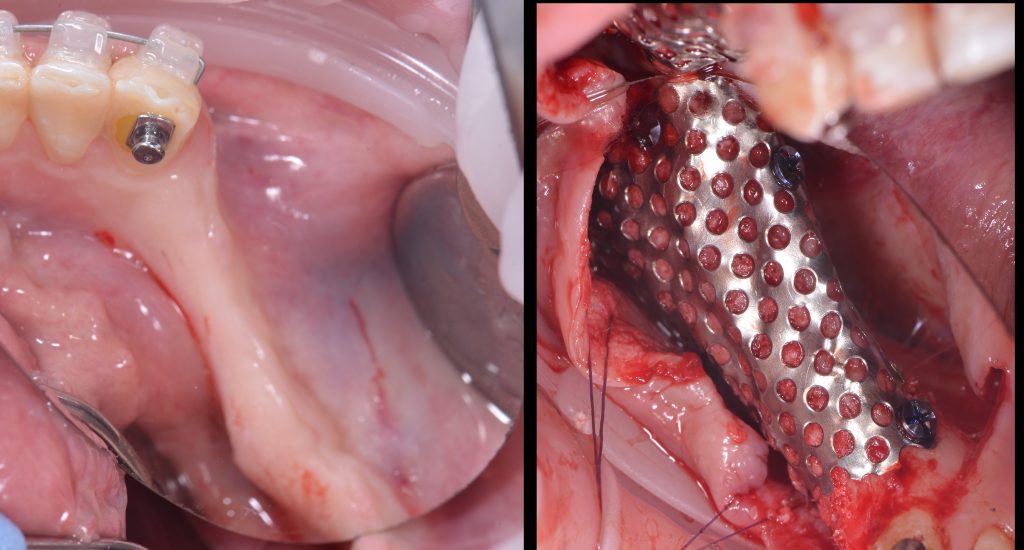 Case study - Reconstruction of the alveolar ridge using Diagnocat AI 10 Case study - Reconstruction of the alveolar ridge using Diagnocat AI 9