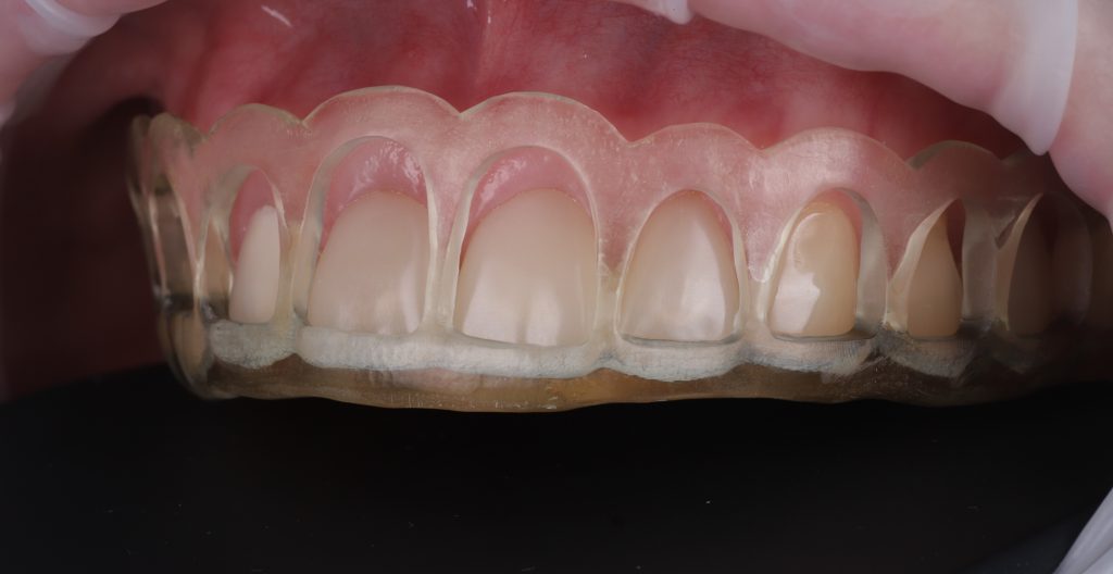 Коррекция розовой эстетики 10 Коррекция розовой эстетики 9