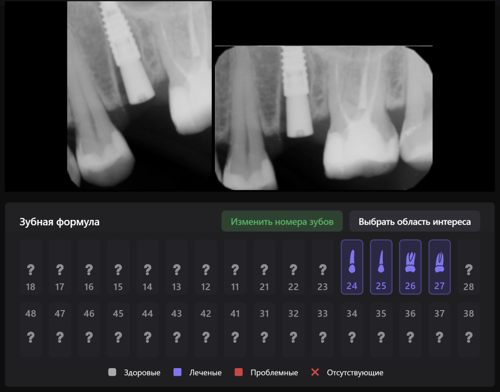 Случай из практики - планирование одномоментной имплантации с помощью ИИ Diagnocat