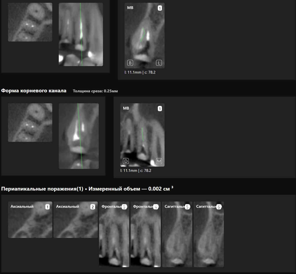 Случай из практики - экструзия зуба с помощью ортодонтической конструкции 10 Случай из практики - экструзия зуба с помощью ортодонтической конструкции 9