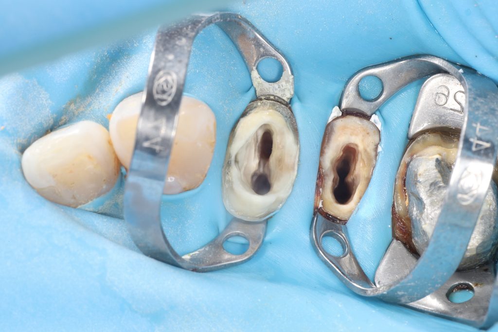 Fallstudie - Kieferorthopädischer Behandlungsplan nach Zahnextraktion 10 Fallstudie - Kieferorthopädischer Behandlungsplan nach Zahnextraktion 9