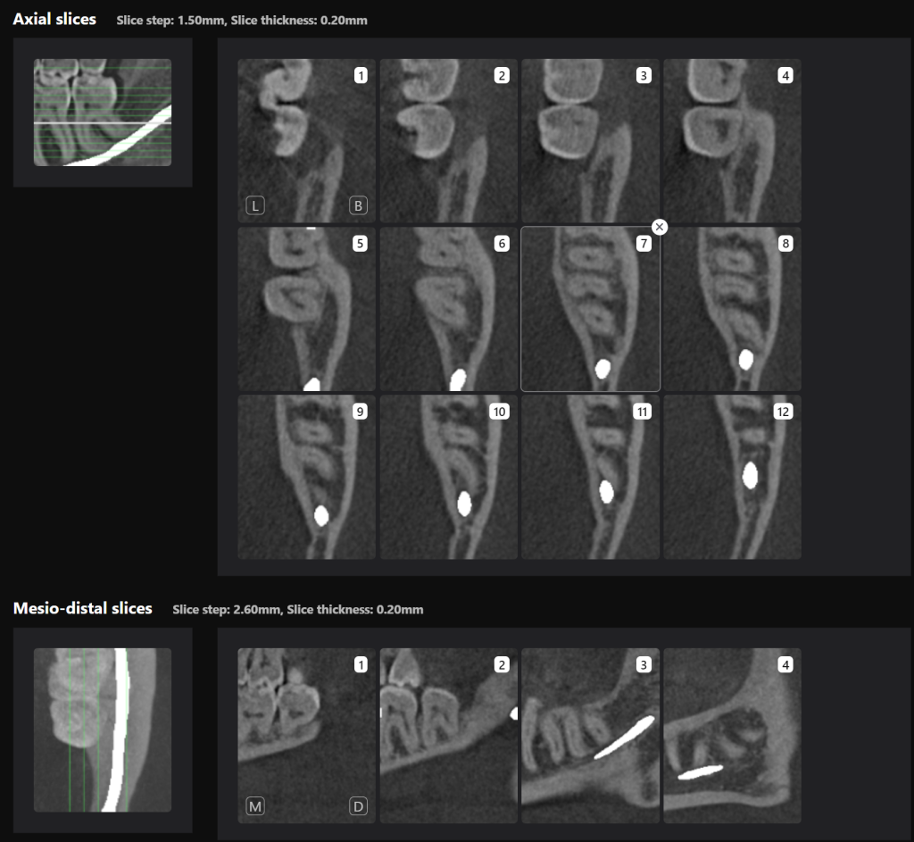 Case study - Treatment plan for atraumatic extractions 10 Case study - Treatment plan for atraumatic extractions 9