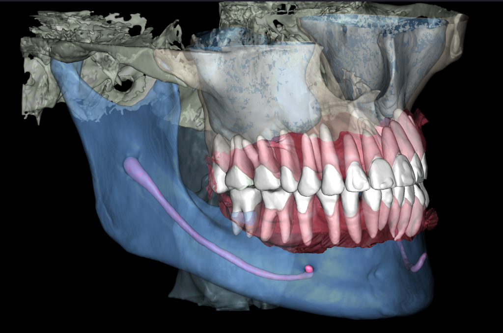 Total prosthetic rehabilitation - case study 12 Total prosthetic rehabilitation - case study 11