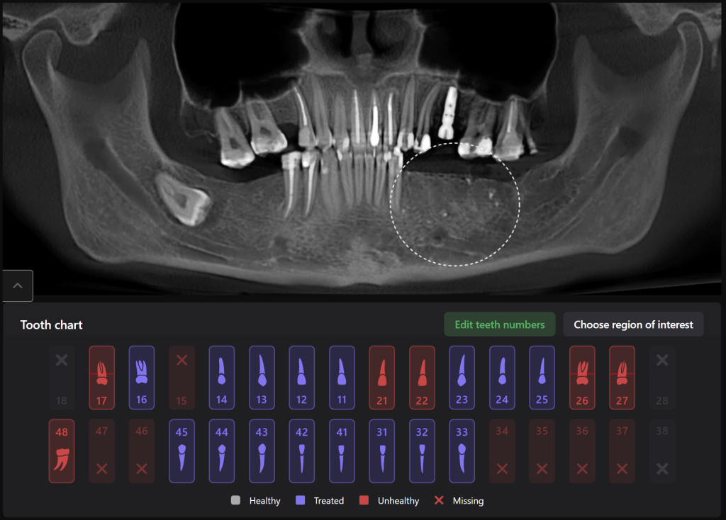 Case study - Reconstruction of the alveolar ridge using Diagnocat AI 12 Case study - Reconstruction of the alveolar ridge using Diagnocat AI 11