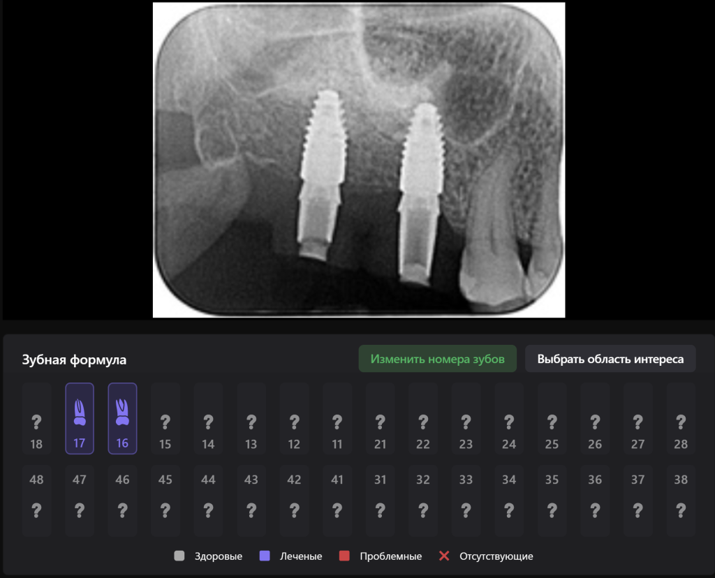 Планирование имплантации 12 Планирование имплантации 11