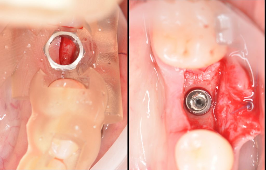 Case study: Implant planning for missing 36 (Universal 19) 10 Case study: Implant planning for missing 36 (Universal 19) 9