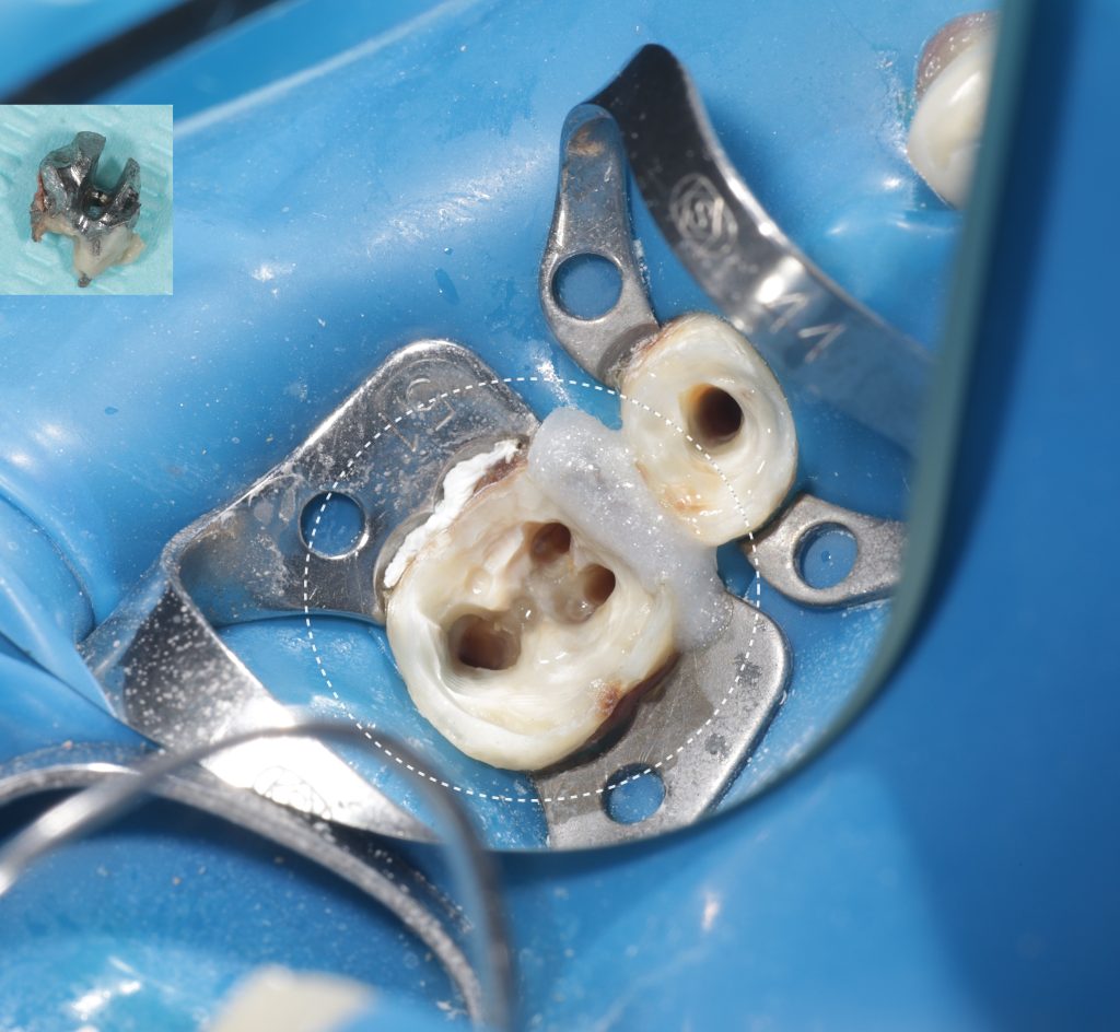 Случай из практики - планирование тотальной ортопедической реабилитации 12 Случай из практики - планирование тотальной ортопедической реабилитации 11