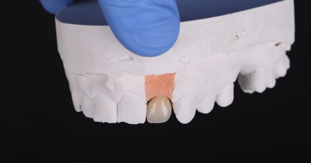 Планирование имплантации зуба в эстетически важной зоне 12 Планирование имплантации зуба в эстетически важной зоне 11