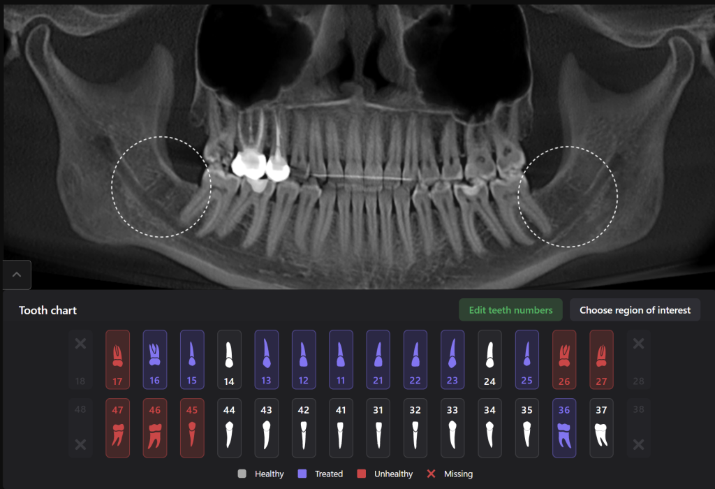 Case study - Treatment plan for atraumatic extractions 12 Case study - Treatment plan for atraumatic extractions 11