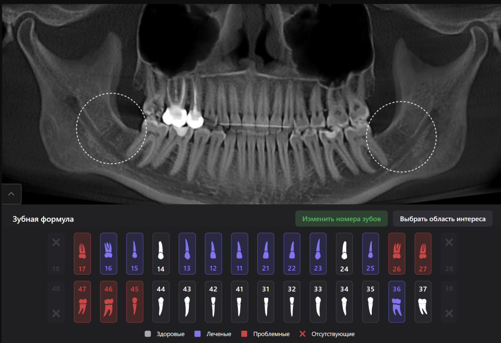 Пример из практики - планирование атравматичного удаления 8 зубов 12 Пример из практики - планирование атравматичного удаления 8 зубов 11