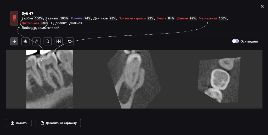Рентгенологический отчет Diagnocat - особые возможности 12 Рентгенологический отчет Diagnocat - особые возможности 11