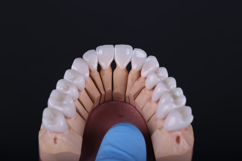 Total prosthetic rehabilitation - case study 14 Total prosthetic rehabilitation - case study 13