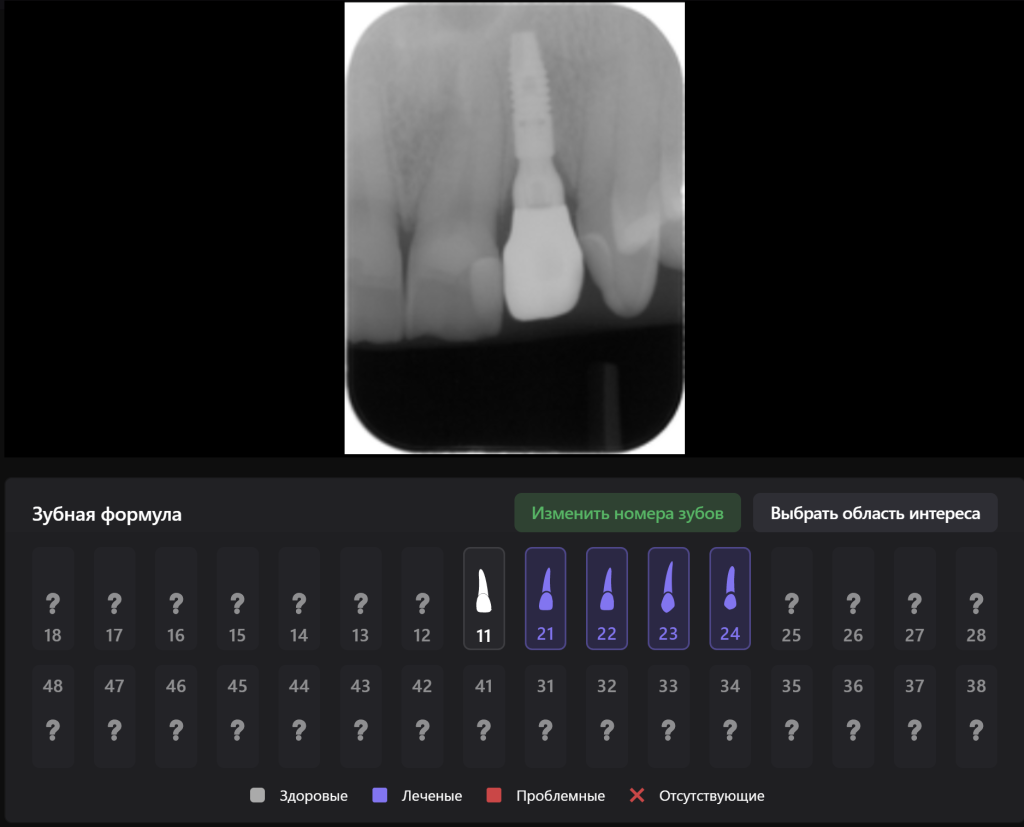 Планирование имплантации зуба в эстетически важной зоне 14 Планирование имплантации зуба в эстетически важной зоне 13