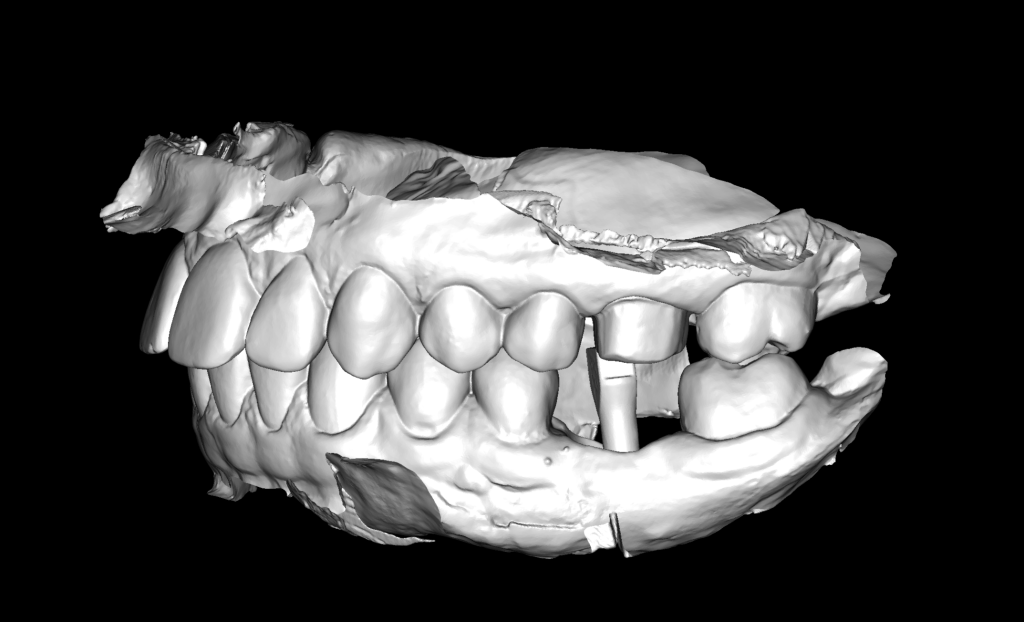 Case study: Implant planning for missing 36 (Universal 19) 14 Case study: Implant planning for missing 36 (Universal 19) 13
