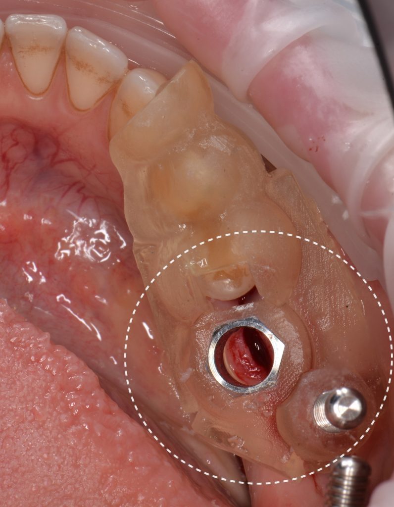 Implant placement using Diagnocat modules 16 Implant placement using Diagnocat modules 15