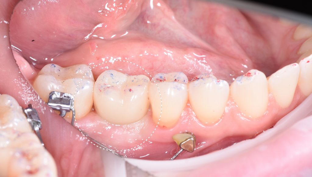 Case study: Implant planning for missing 36 (Universal 19) 16 Case study: Implant planning for missing 36 (Universal 19) 15