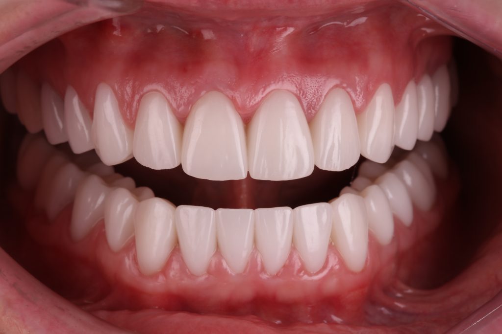 Случай из практики - планирование тотальной ортопедической реабилитации 18 Случай из практики - планирование тотальной ортопедической реабилитации 17