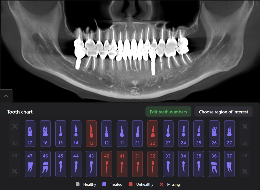 Total prosthetic rehabilitation - case study 18 Total prosthetic rehabilitation - case study 17