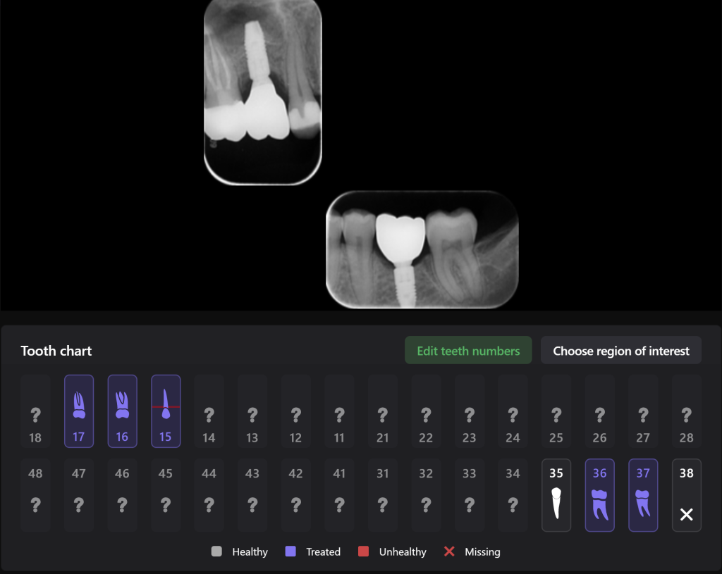 Case study: Implant planning for missing 36 (Universal 19) 18 Case study: Implant planning for missing 36 (Universal 19) 17
