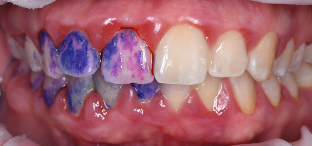 Treatment of severe periodontal disease 2 Treatment of severe periodontal disease 1