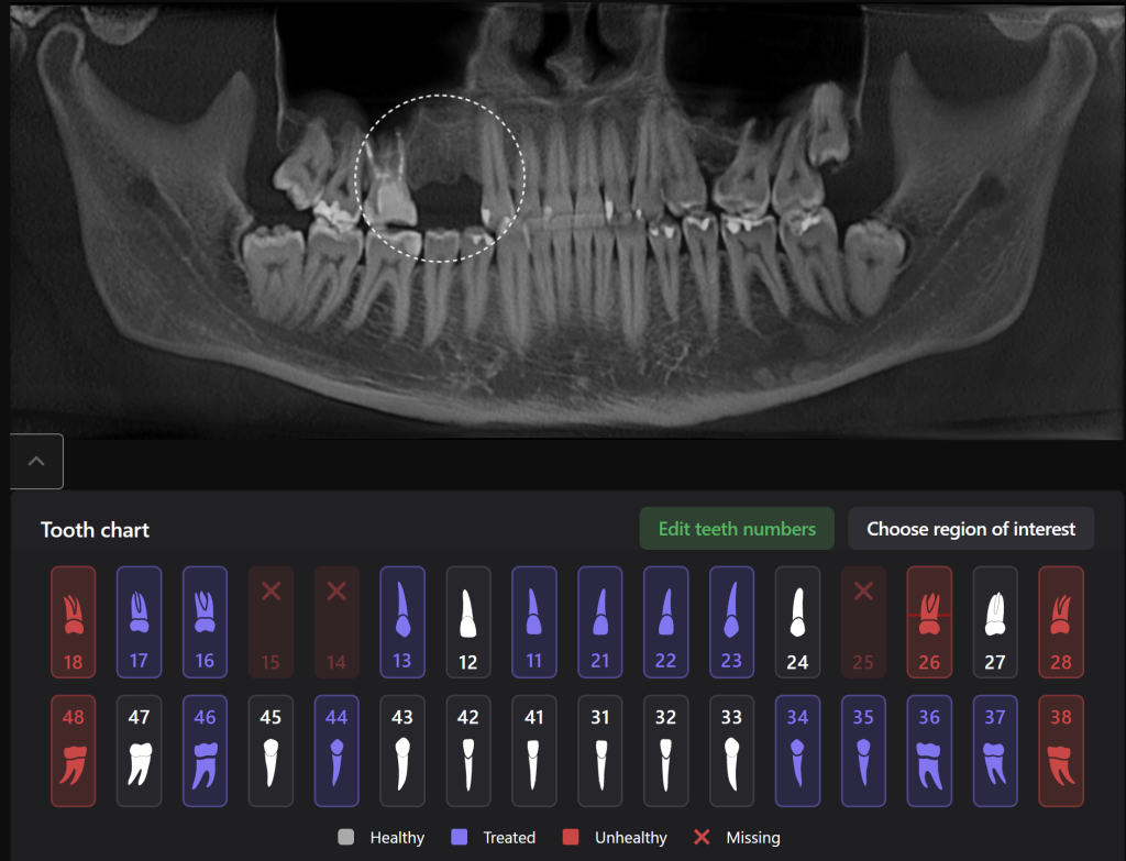Planning implantation using Diagnocat AI 2 Planning implantation using Diagnocat AI 1