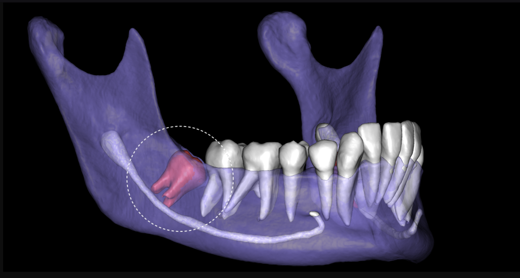 Planung der Extraktion des dritten Molaren mit Diagnocat 2 Planung der Extraktion des dritten Molaren mit Diagnocat 1
