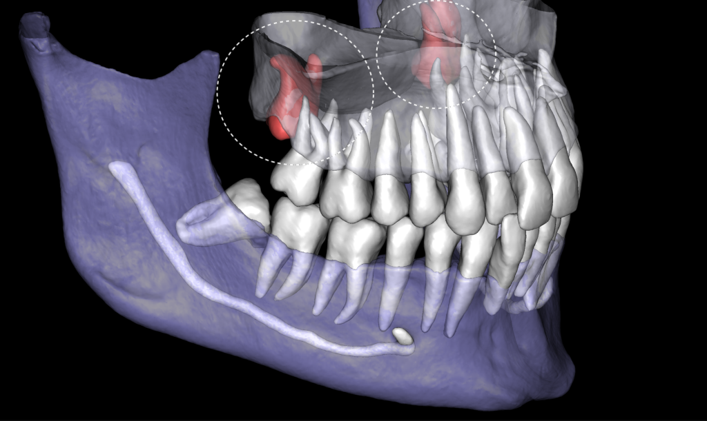 How to carefully plan the third molar extraction? 2 How to carefully plan the third molar extraction? 1