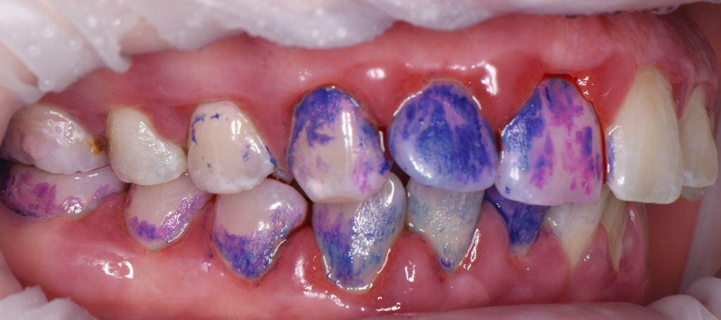 Treatment of severe periodontal disease 4 Treatment of severe periodontal disease 3