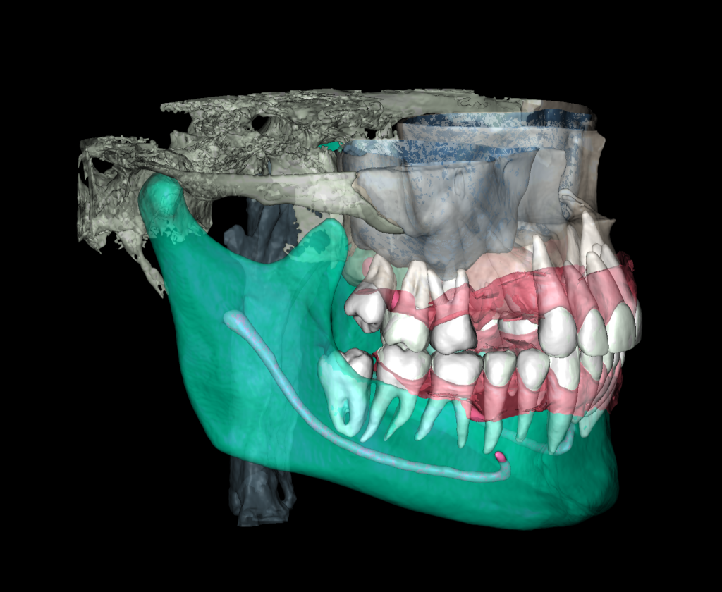 Planning implantation using Diagnocat AI 4 Planning implantation using Diagnocat AI 3