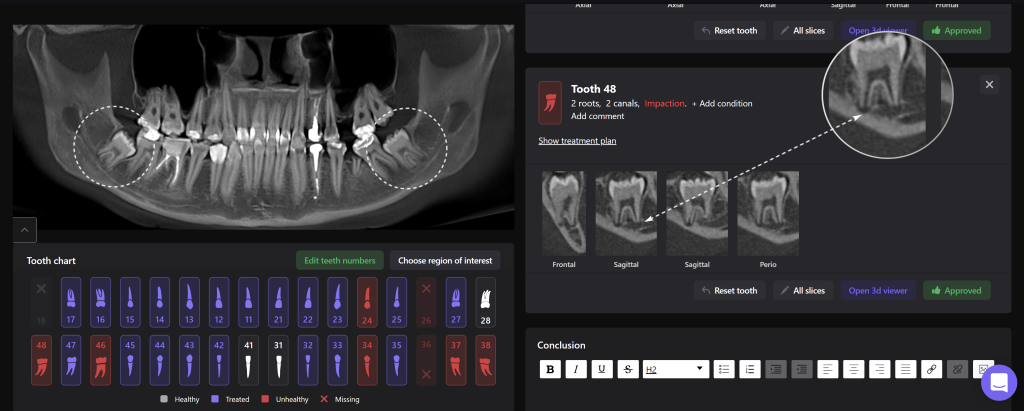 Planung der Extraktion des dritten Molaren mit Diagnocat 4 Planung der Extraktion des dritten Molaren mit Diagnocat 3