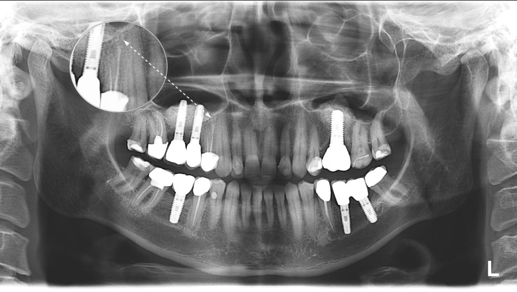 2D vs 3D (PANO vs CBCT) Who's gonna win? 4 2D vs 3D (PANO vs CBCT) Who's gonna win? 3