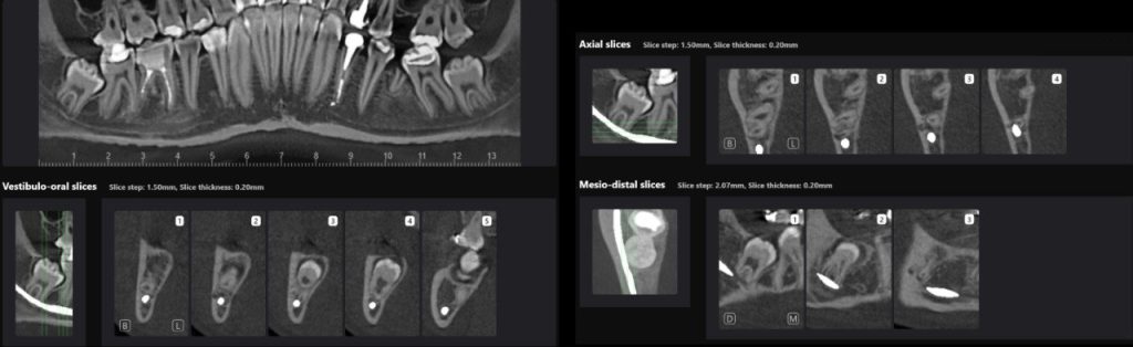 How to carefully plan the third molar extraction? 4 How to carefully plan the third molar extraction? 3