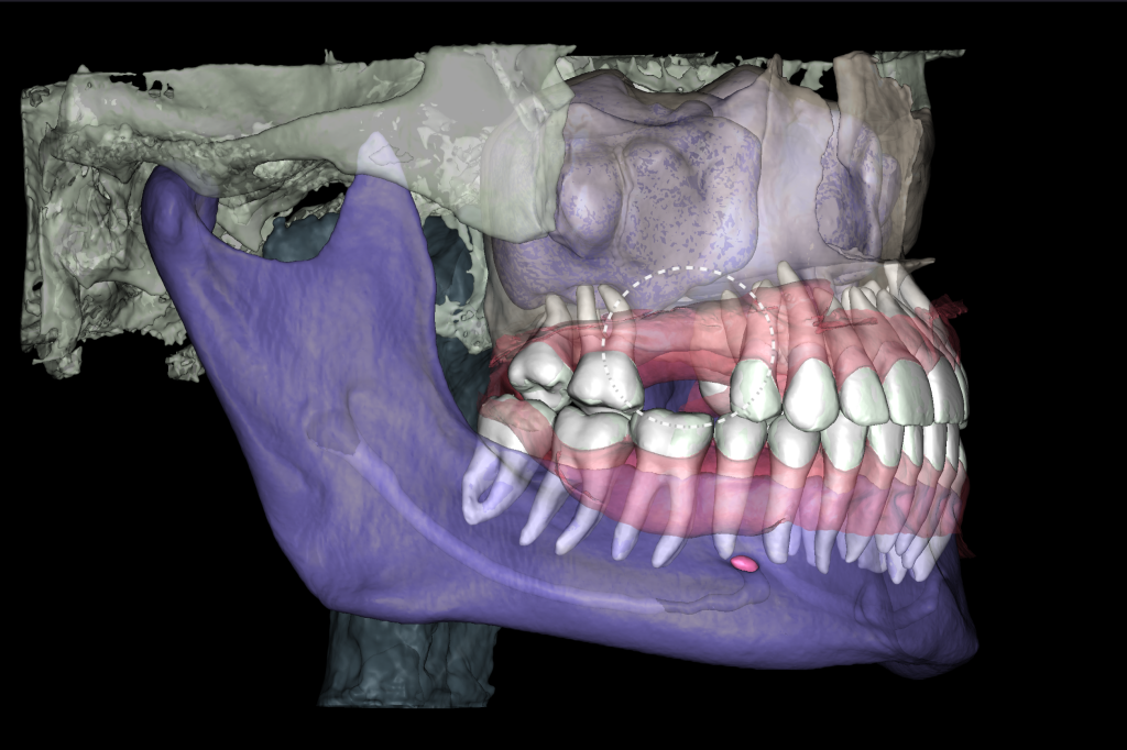 Planning guided implant surgery with Diagnocat 6 Planning guided implant surgery with Diagnocat 5