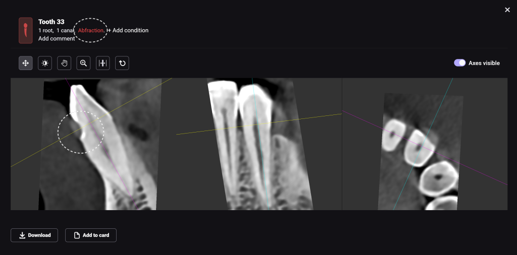 Automatic detection of non-carious lesions 6 Automatic detection of non-carious lesions 5