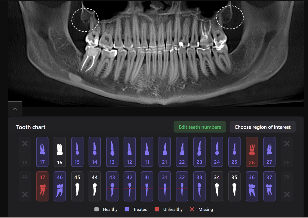 How to carefully plan the third molar extraction? 6 How to carefully plan the third molar extraction? 5
