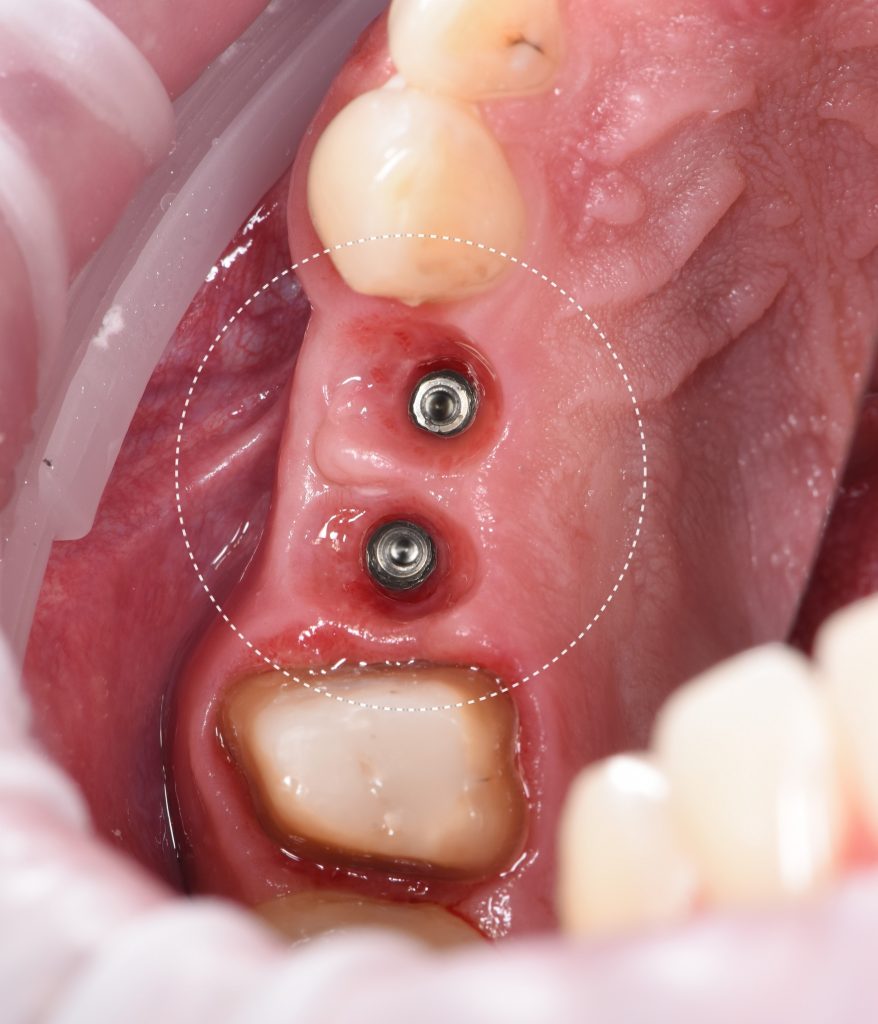 Planning implantation using Diagnocat AI 6 Planning implantation using Diagnocat AI 5