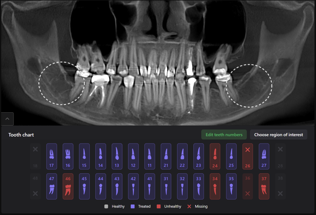 Planung der Extraktion des dritten Molaren mit Diagnocat 8 Planung der Extraktion des dritten Molaren mit Diagnocat 7