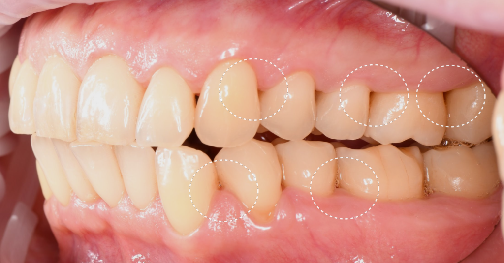 Timely periodontal screening with Diagnocat - the key to successful treatment result 8 Timely periodontal screening with Diagnocat - the key to successful treatment result 7
